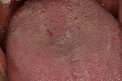 Langue p4glbe - Eugenol