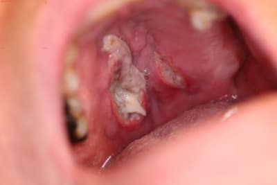 Lesion muqueuse1 gtjzsz - Eugenol