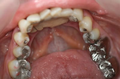 Lingual mxpczq - Eugenol