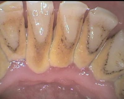 Mais si je vous promet que je me brosse les dents zax5xa - Eugenol