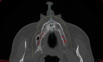 Med axial brysp2 - Eugenol