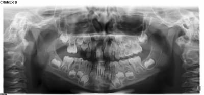 Mesiodens wnaibb - Eugenol