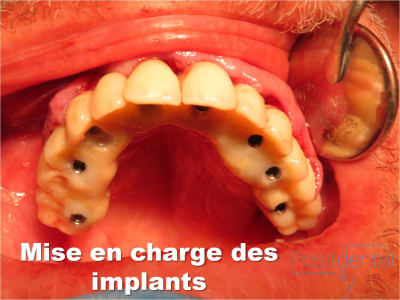 Mise en charge immédiate   implant tov  positdental 016 i1klls - Eugenol