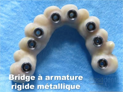 Mise en charge immédiate   implant tov  positdental 020 bgcsfh - Eugenol