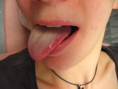 Morsure njy0sx - Eugenol