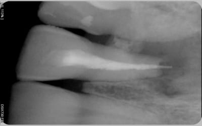 Obturation ocz3kw - Eugenol
