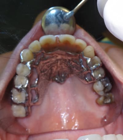 Occlusal avec appareil k4ad1h - Eugenol