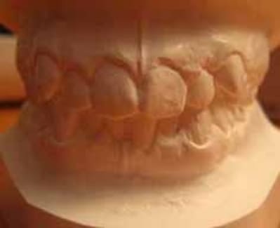 Occlusion face inthh7 - Eugenol