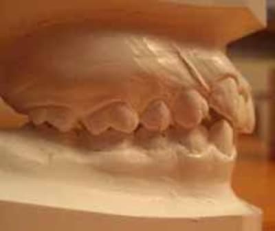 Occlusion profil w9lh06 - Eugenol