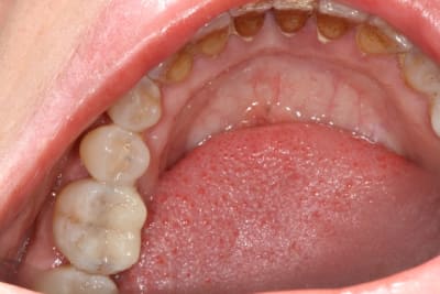 Onlay hsygex - Eugenol