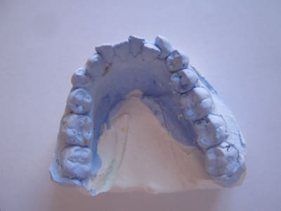 Orthodontie hanguag siham debut de traitement 001 fk1jzx - Eugenol