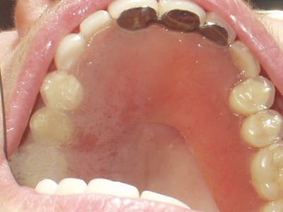 Overdenture  1  g8wj2g - Eugenol