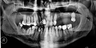 Pano bifpbd - Eugenol
