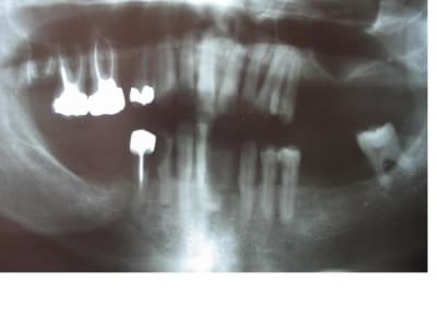 Paro severe pano tlutlu - Eugenol
