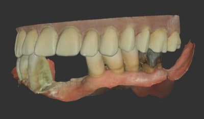 Partiel bas occlusion xtdxfu - Eugenol