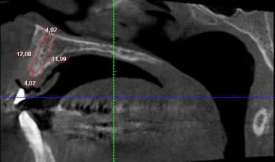 Patient implant ant obof5n - Eugenol