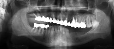 Patient m4wmmp - Eugenol