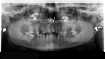 Patiente50ans n1bouk - Eugenol