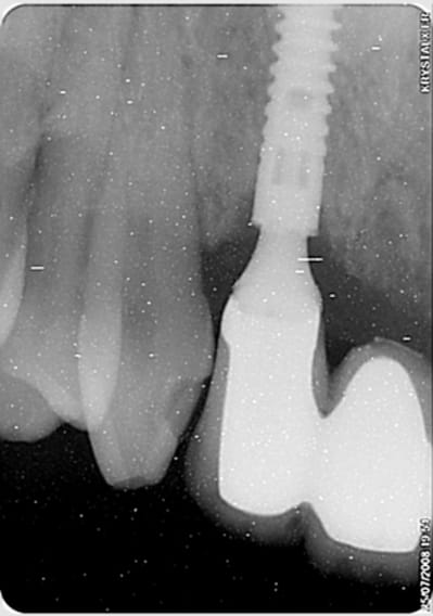 Perimplantite 2 fk11pb - Eugenol