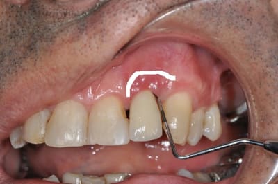 Petiimplantite bk0xsl - Eugenol