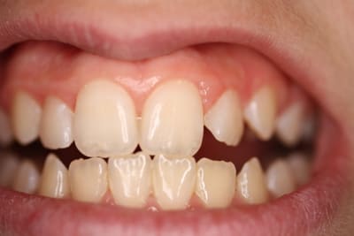 Photo damien dents 019 pycbpi - Eugenol
