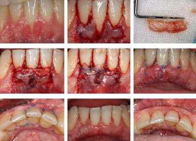 Planche conjonctif enfoui et lambeau bipapillaire dkrapj - Eugenol