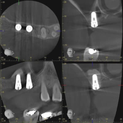 Poley controle sinus cakvjl - Eugenol