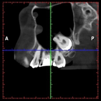Polypes 3 pgmnkj - Eugenol