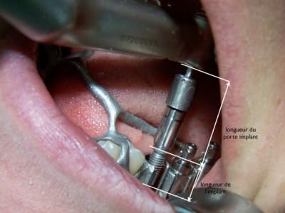 Porte implant scnt85 - Eugenol
