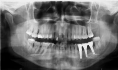 Post dnjhil - Eugenol