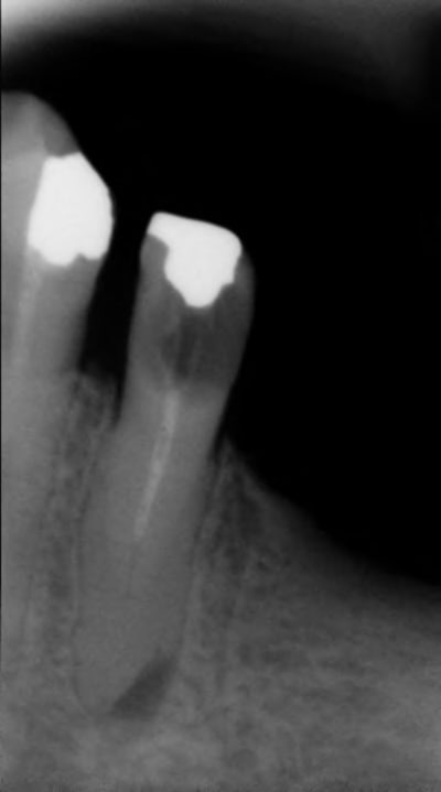 Pr molaire pjohod - Eugenol