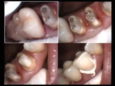 Proceras bidets 16 et 14 et 13 lijcfv - Eugenol