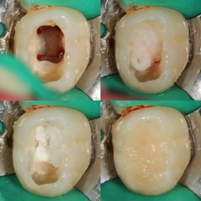 Pulpo2 001 mpr2v1 - Eugenol