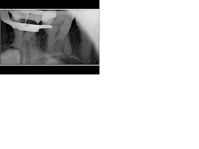 Radio 3 vcfacl - Eugenol