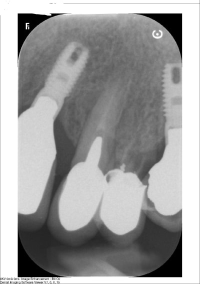 Radiographie os87ju - Eugenol