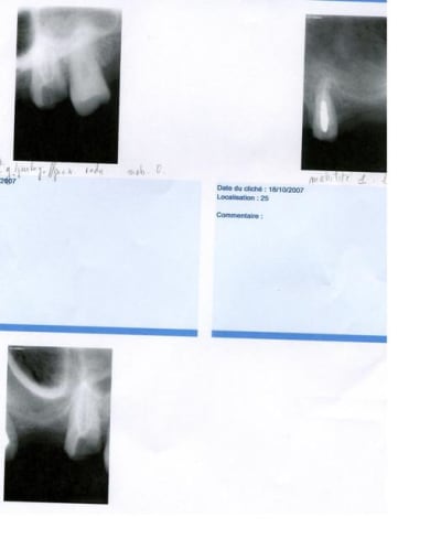Retros osulti - Eugenol