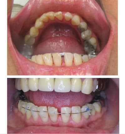 Rotation et diastème mdlhww - Eugenol