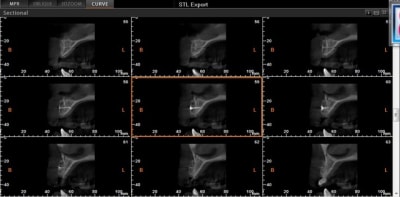 Scan post op tzfllb - Eugenol
