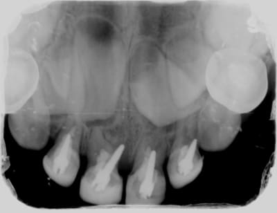 Screwpost tmi3iy - Eugenol