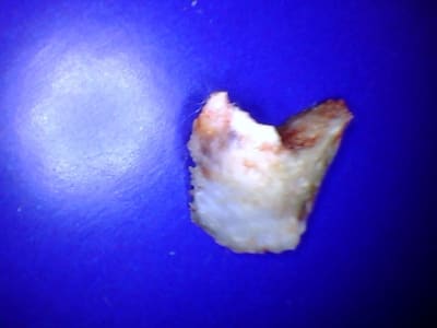 Sequestre osseux 2013 08 22 184425 tpst8k - Eugenol