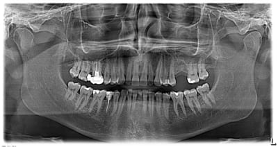 Sinus droit z9qhgk - Eugenol