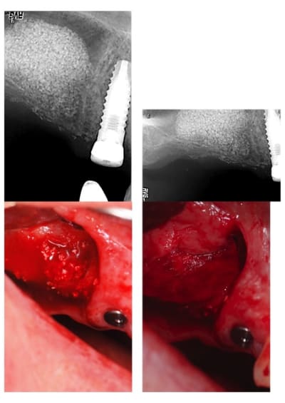 Sinus lift 2 2 am71bi - Eugenol