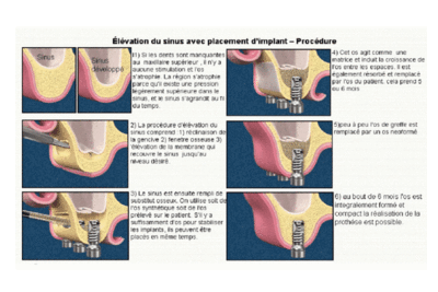 Sinus lift i6pujz - Eugenol