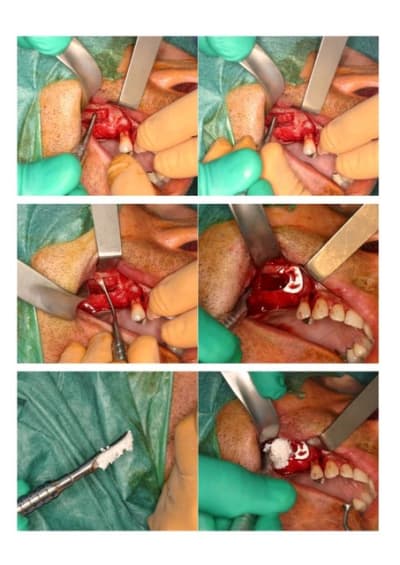 Sinuslift2 yfde9v - Eugenol