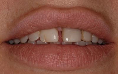 Smile2 hlzmjy - Eugenol