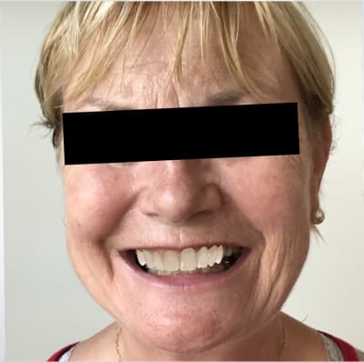 Sourire de simone iaujvk - Eugenol