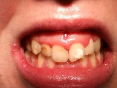 Sourire sfkgeo - Eugenol