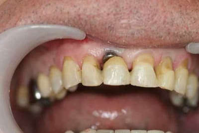 Splint  fljqww - Eugenol