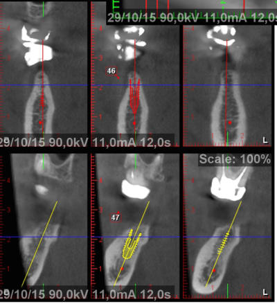 Split3 hydlqb - Eugenol