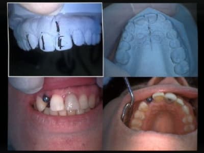 Sutures enlevées  axe à corriger r9giw9 - Eugenol